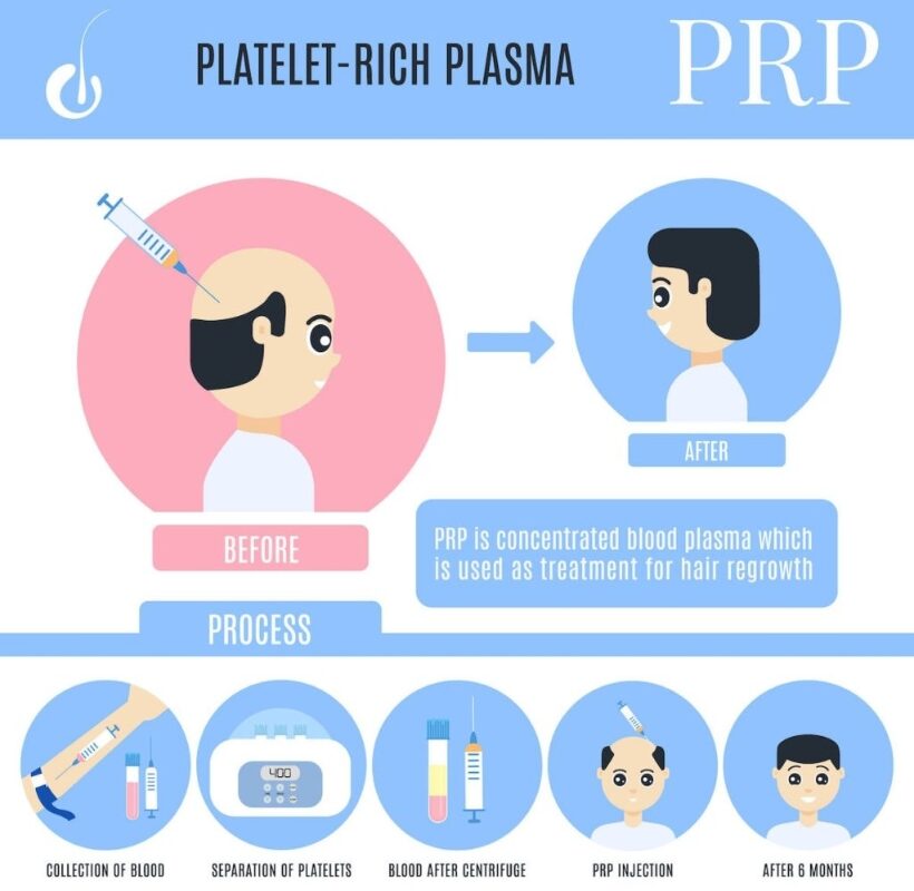 Stages-of-PRP-procedure-hair-loss-treatment